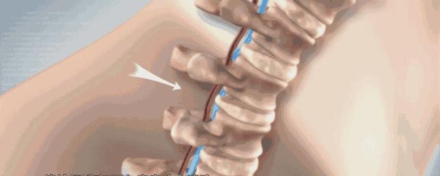 脖子后颈僵硬酸痛怎么缓解,脖子肩膀僵硬酸痛买什么膏药