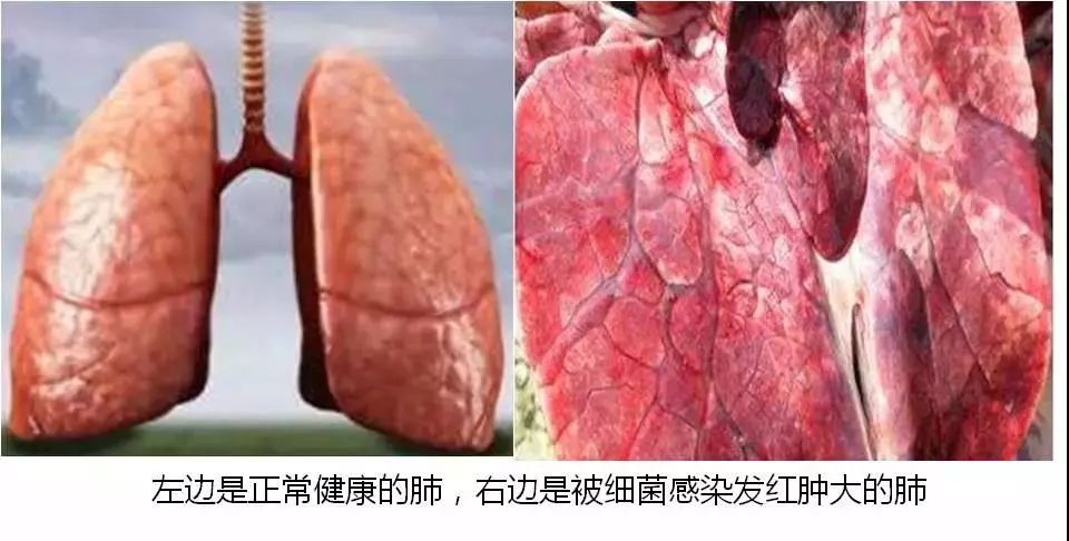 20年烟民咽喉发黑，瑞士专业医师推荐！一喷杀菌99.9%，止咳清痰排烟毒
