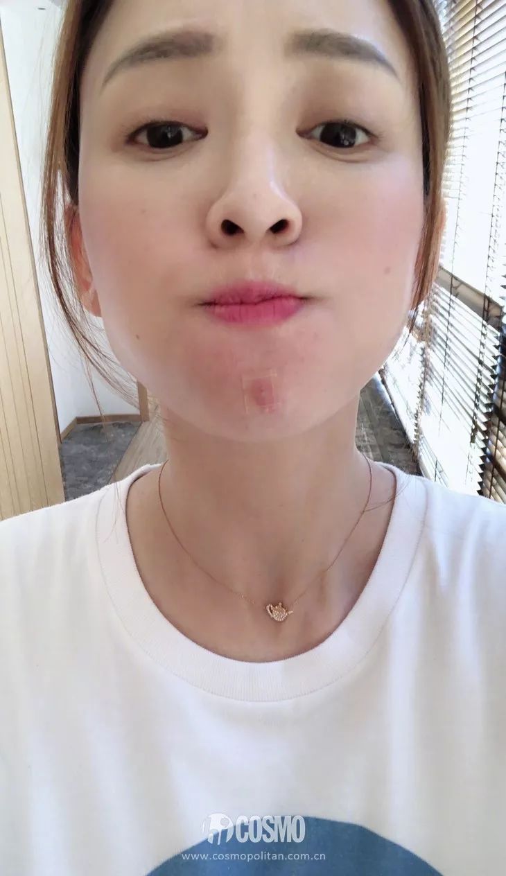 沈梦辰治痘方法,沈梦辰痘痘怎么治