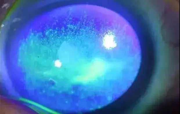 眼睛一招去除红血丝眼药水,消除眼红血丝眼药水