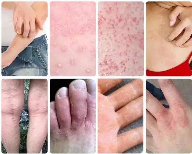 脚气湿疹止痒最快的软膏,湿疹止痒膏能够治脚气吗