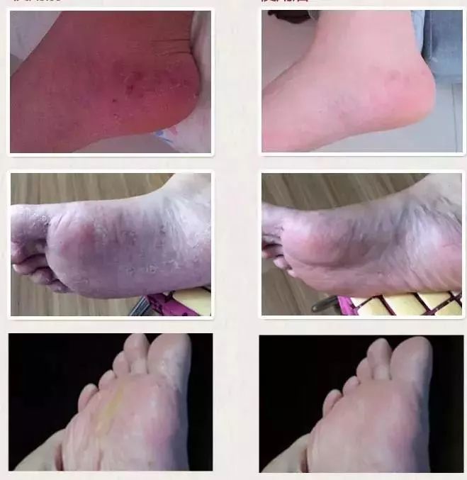 脚气湿疹止痒最快的软膏,湿疹止痒膏能够治脚气吗