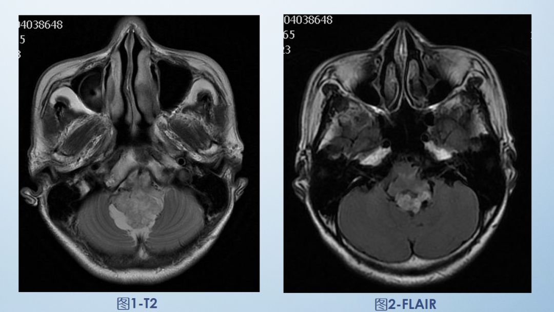 影像病例学习（3）：后颅窝实性占位病变