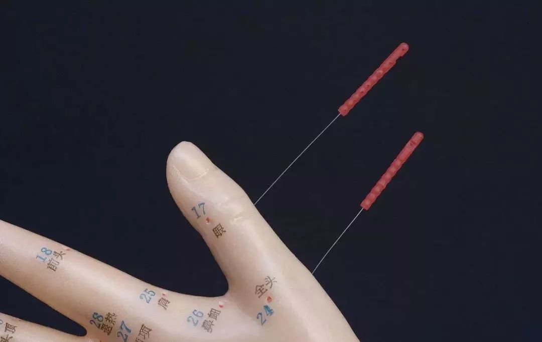 针灸能缓解更年期症状吗？