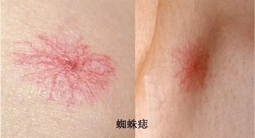 肝癌胸前小红痣样子,身体出现这种痣可能是肝癌