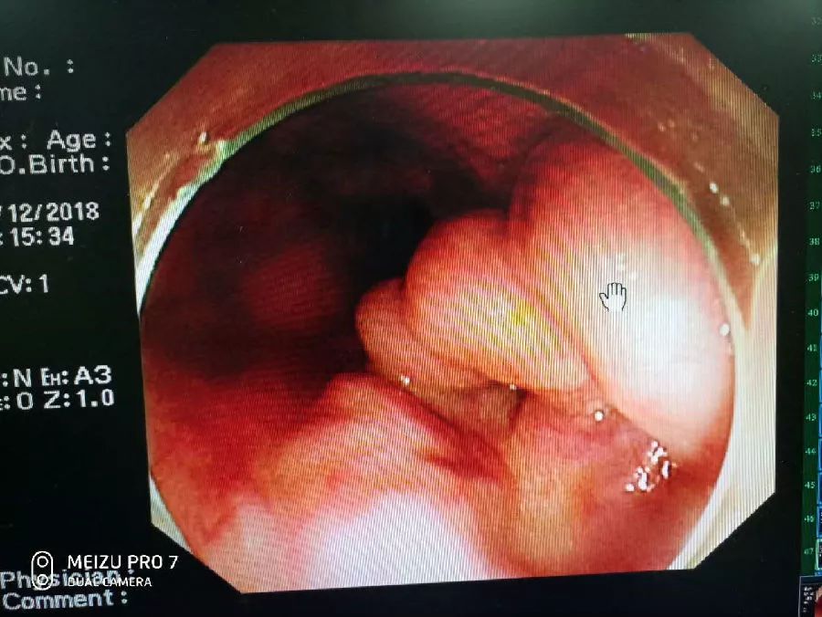 肝硬化食管胃底静脉曲张破裂出血,胃底静脉曲张破裂出血病历