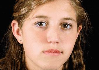 5个祛斑小妙招淡化晒斑雀斑痘印,痘印晒斑和疤痕用什么产品比较好