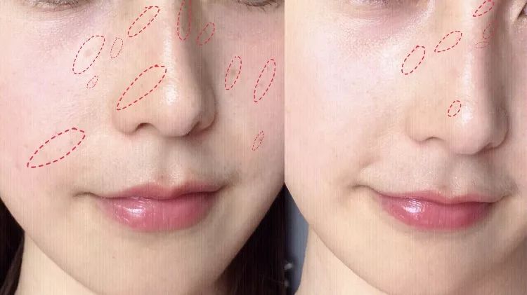 5个祛斑小妙招淡化晒斑雀斑痘印,痘印晒斑和疤痕用什么产品比较好