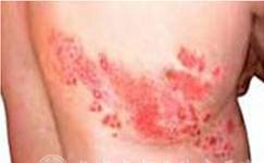 蛇盘疮带状疱疹能够吃病毒灵吗 (蛇缠头带状疱疹)