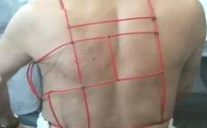 蛇盘疮带状疱疹能够吃病毒灵吗 (蛇缠头带状疱疹)