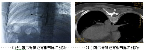 蛇盘疮带状疱疹能够吃病毒灵吗 (蛇缠头带状疱疹)
