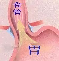 胃反酸烧心怎样扎针,烧心反酸八年吃哪种中成药