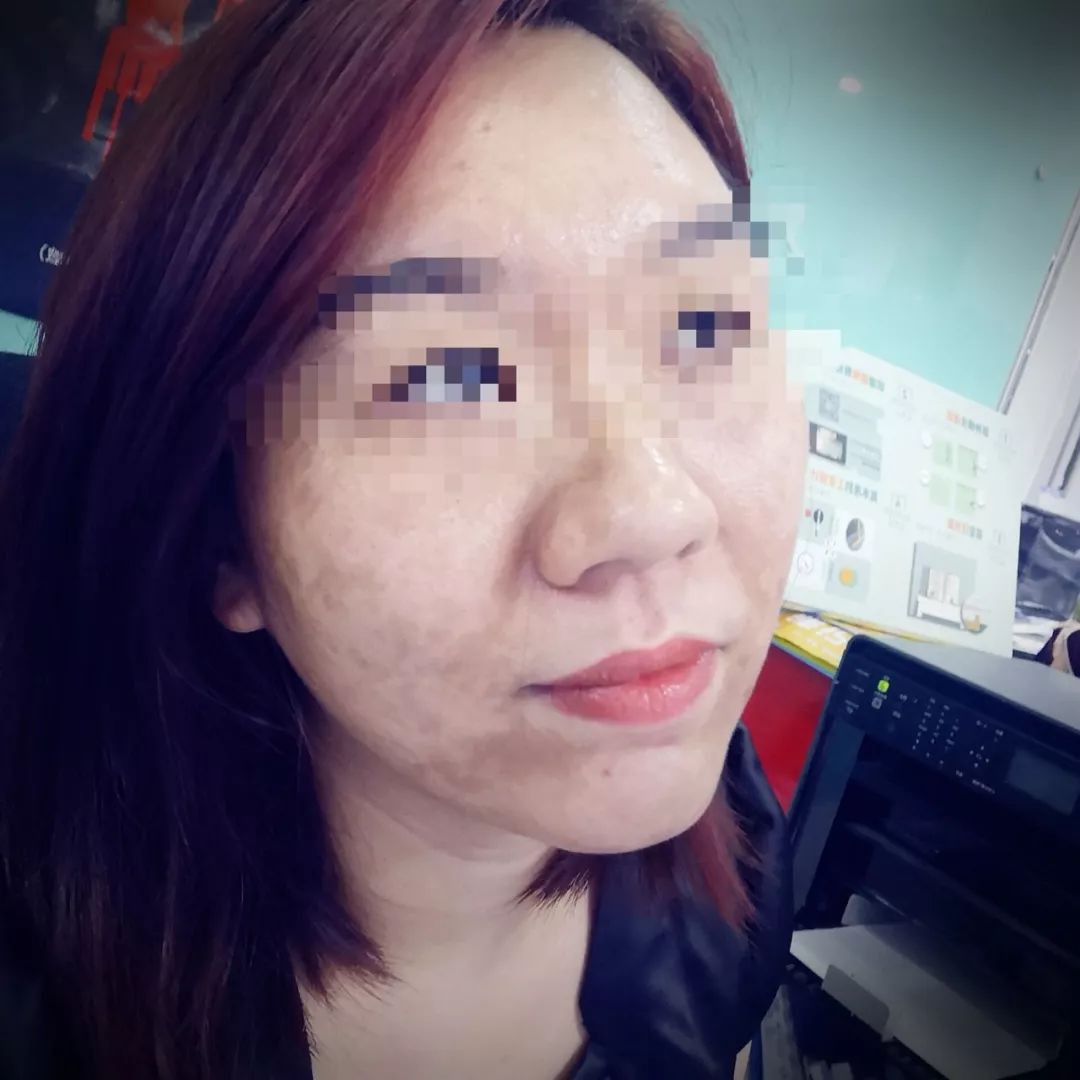 南宁一大学老师在整形医院“打针”后满脸长斑！“医生”竟没有执业证