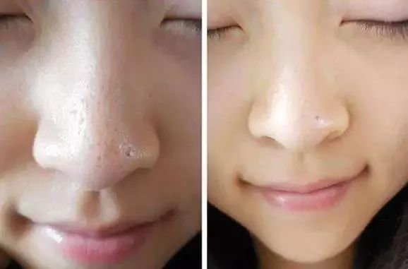 拨黑头工具草莓鼻,去黑头神器真的能吸出黑头