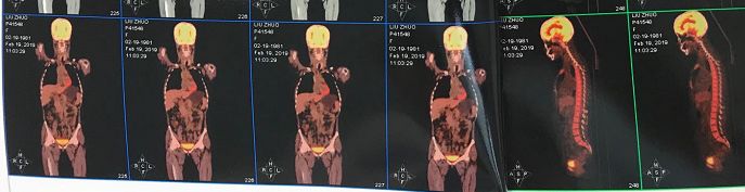 泰国回来后得白血病,泰国回来得了癌症