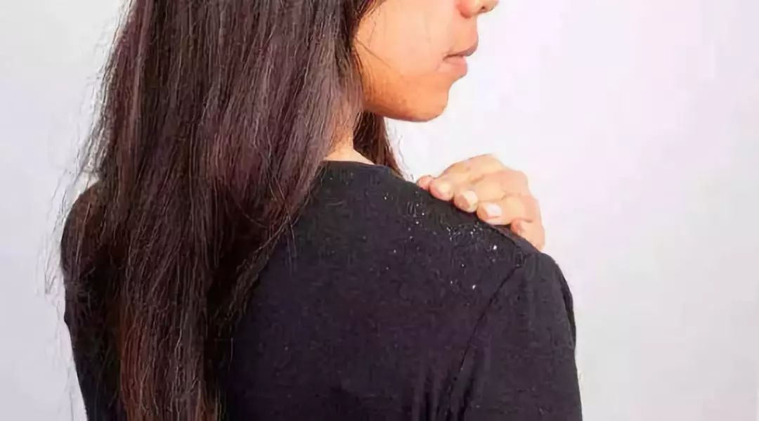 头皮屑多的解决方法小妙招,头皮屑突然增多的原因和解决方法