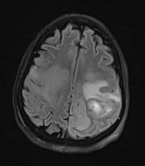 如何平稳度过脑水肿,多种原因导致的脑水肿首选是什么