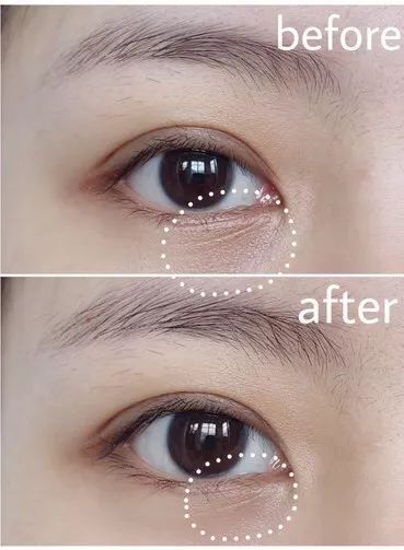 25岁必须用眼霜了吗,25岁之后合适用什么眼霜