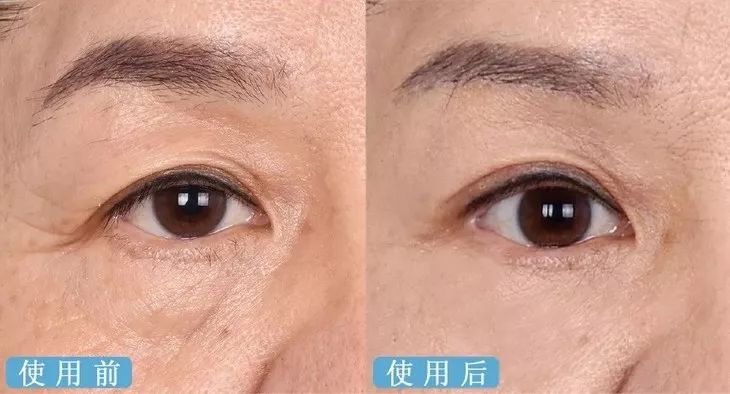 德国变态震动棒，啪啪啪间抚平眼袋、黑眼圈！不用开刀，就能让你年轻十岁！