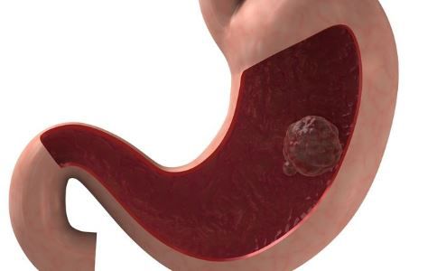 什么是胃癌肿瘤免疫治疗,胃癌预防宣传知识