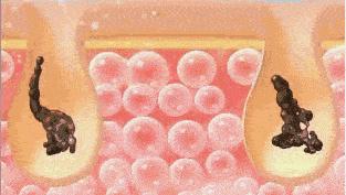 怎样高效快速去黑头,如何快速高效的去黑头