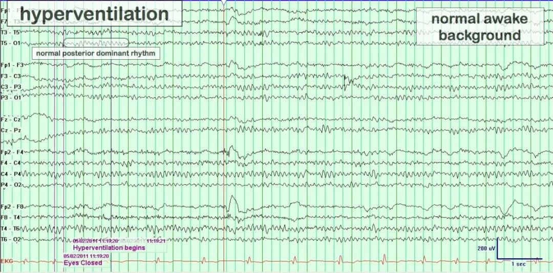 正常脑电图报告单图片,正常脑电图检查报告单第一页