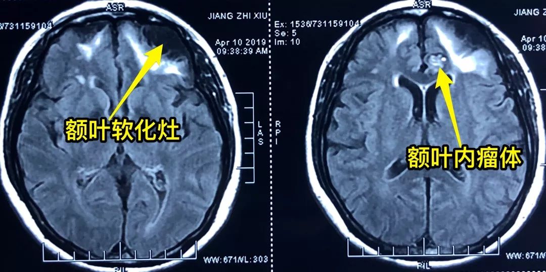 头晕头疼脑里长了脑瘤,脑袋晕晕沉沉有可能是脑瘤吗