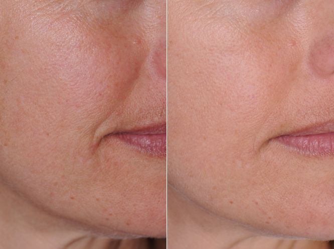 皮肤粗糙暗沉毛孔粗要做什么医美,真正改变毛孔的医美