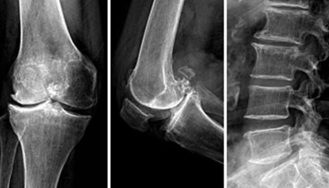 骨关节炎康复训练,骨关节炎的康复治疗行家共识