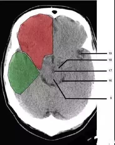 颅脑影像读片教程,颅脑影像读片怎么看