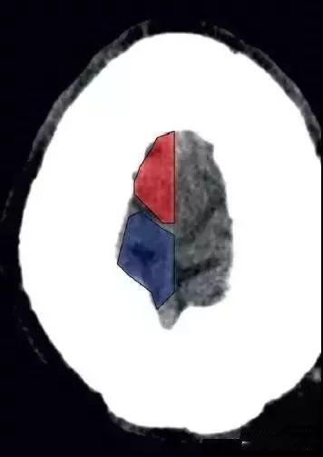 颅脑影像读片教程,颅脑影像读片怎么看