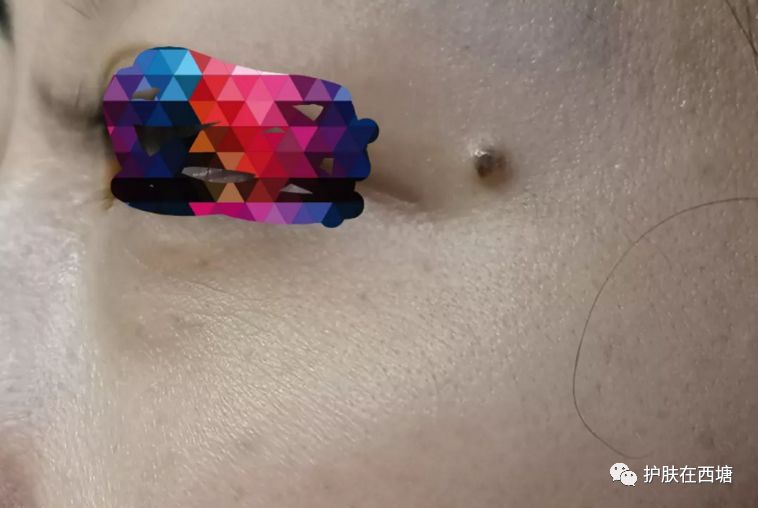 遮痣最简单的方法,褐青色痣的治疗方法