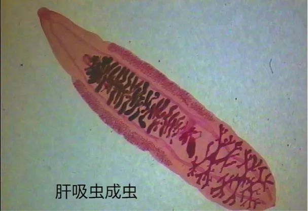 广西发现肝吸虫事件,广西有过几例肝吸虫