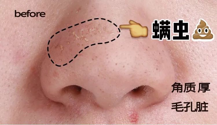 脸上搓出3斤泥！难怪又黄又暗又黑头！10秒给脸蛋“剥壳”，厉害