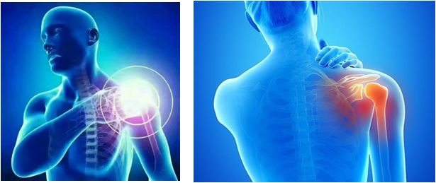 肩周炎讨人嫌，轻轻一灸治疗解烦忧