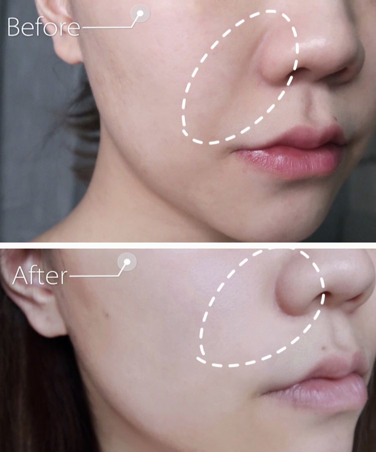 35岁了法令纹鱼尾纹眉间纹怎么办,三十岁就有眉间纹法令纹怎么办