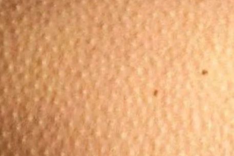 为什么脸上的痘痘那么难消,你脸上的痘痘是螨虫痘吗