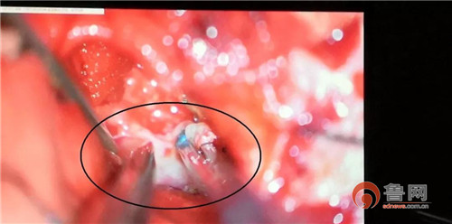 又一例技术突破！天坛医院行家带队，“锥尖”大耳道内切除“花生”大的肿瘤