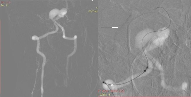 夹层动脉瘤治疗指南,复杂的1型夹层动脉瘤手术