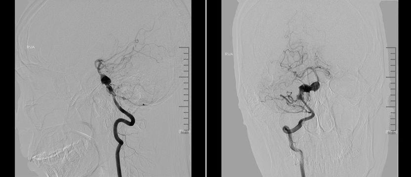 夹层动脉瘤治疗指南,复杂的1型夹层动脉瘤手术