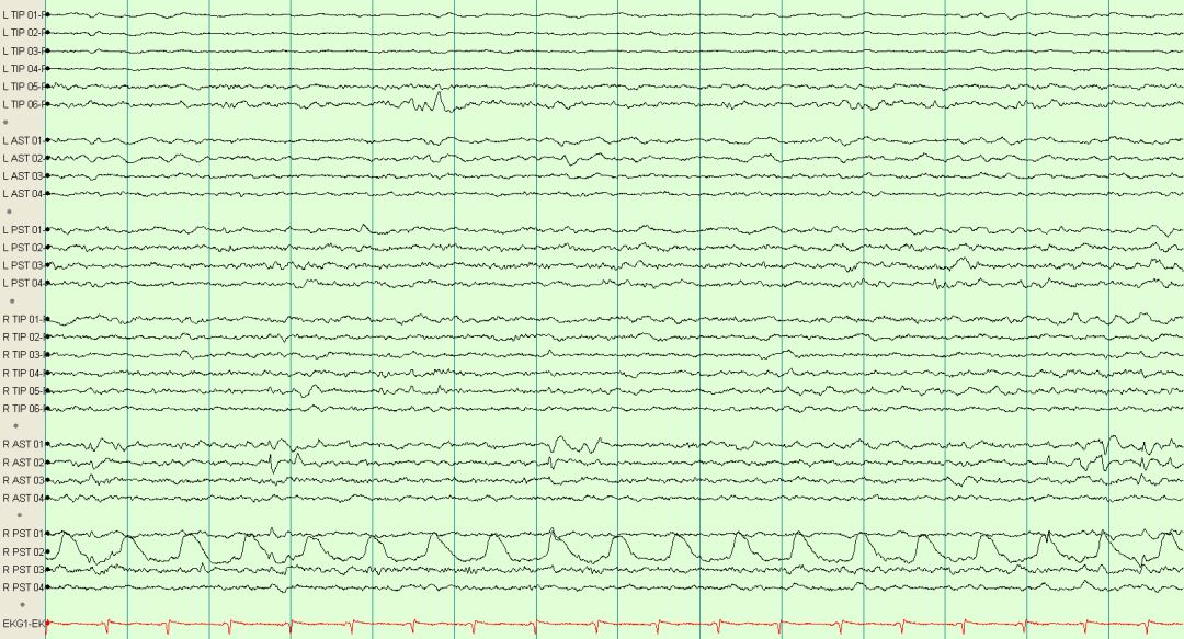 脑电图伪差图,脑电图伪差图谱