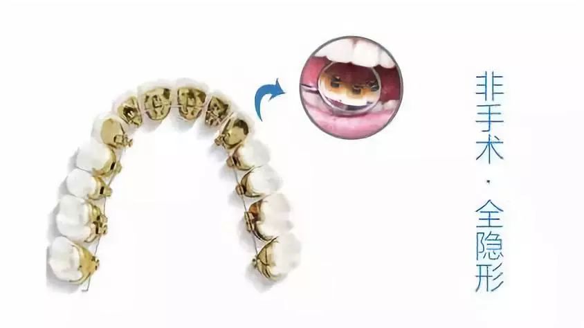 种牙免费送,种牙优惠活动免费检查是真的吗