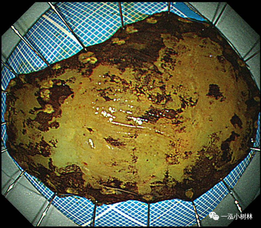 食管癌早期内镜esd治疗能活多久,食管癌内镜esd手术后几天出院