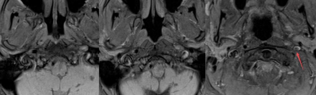 枫糖尿病、血管型梅毒、Hopkins综合征、Susac综合征丨3分钟读片·2期