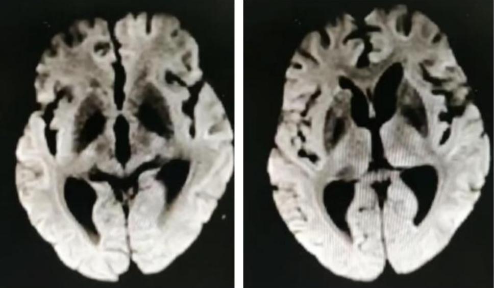 枫糖尿病、血管型梅毒、Hopkins综合征、Susac综合征丨3分钟读片·2期