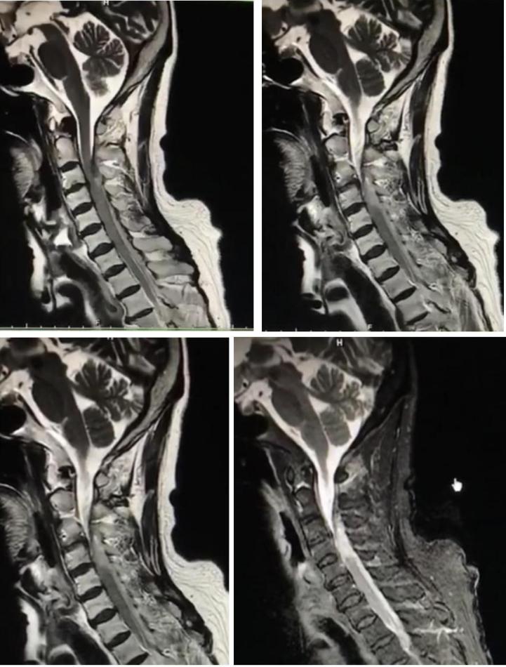 枫糖尿病、血管型梅毒、Hopkins综合征、Susac综合征丨3分钟读片·2期