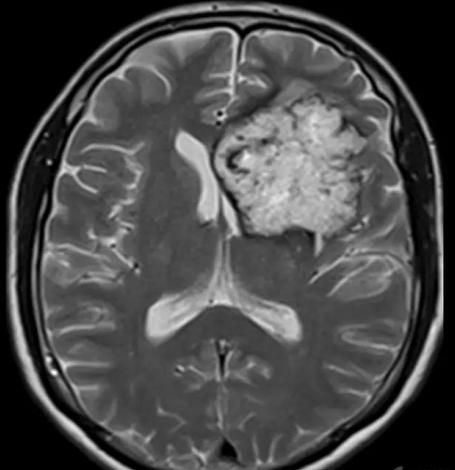 枫糖尿病、血管型梅毒、Hopkins综合征、Susac综合征丨3分钟读片·2期