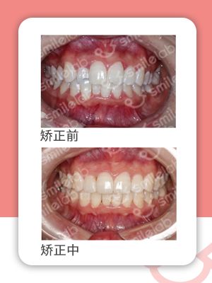 牙齿缝隙大隐形牙套矫正前后对比,牙齿前突隐形牙套矫正的全过程