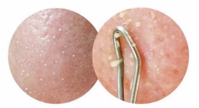 用什么洗脸抑制螨虫生长,用什么洗脸能够抑制螨虫生长