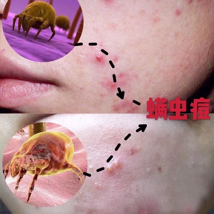 用什么洗脸抑制螨虫生长,用什么洗脸能够抑制螨虫生长
